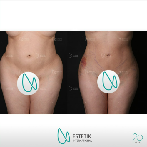 fotos antes y después de nuestros pacientes - Abdominoplastia - Dr. Çağatay Güngörsün